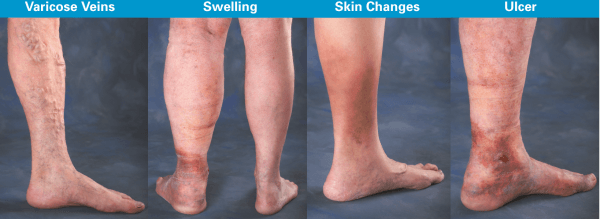 Understanding Vein Disease | San Diego Skin & Vein Laser Clinic