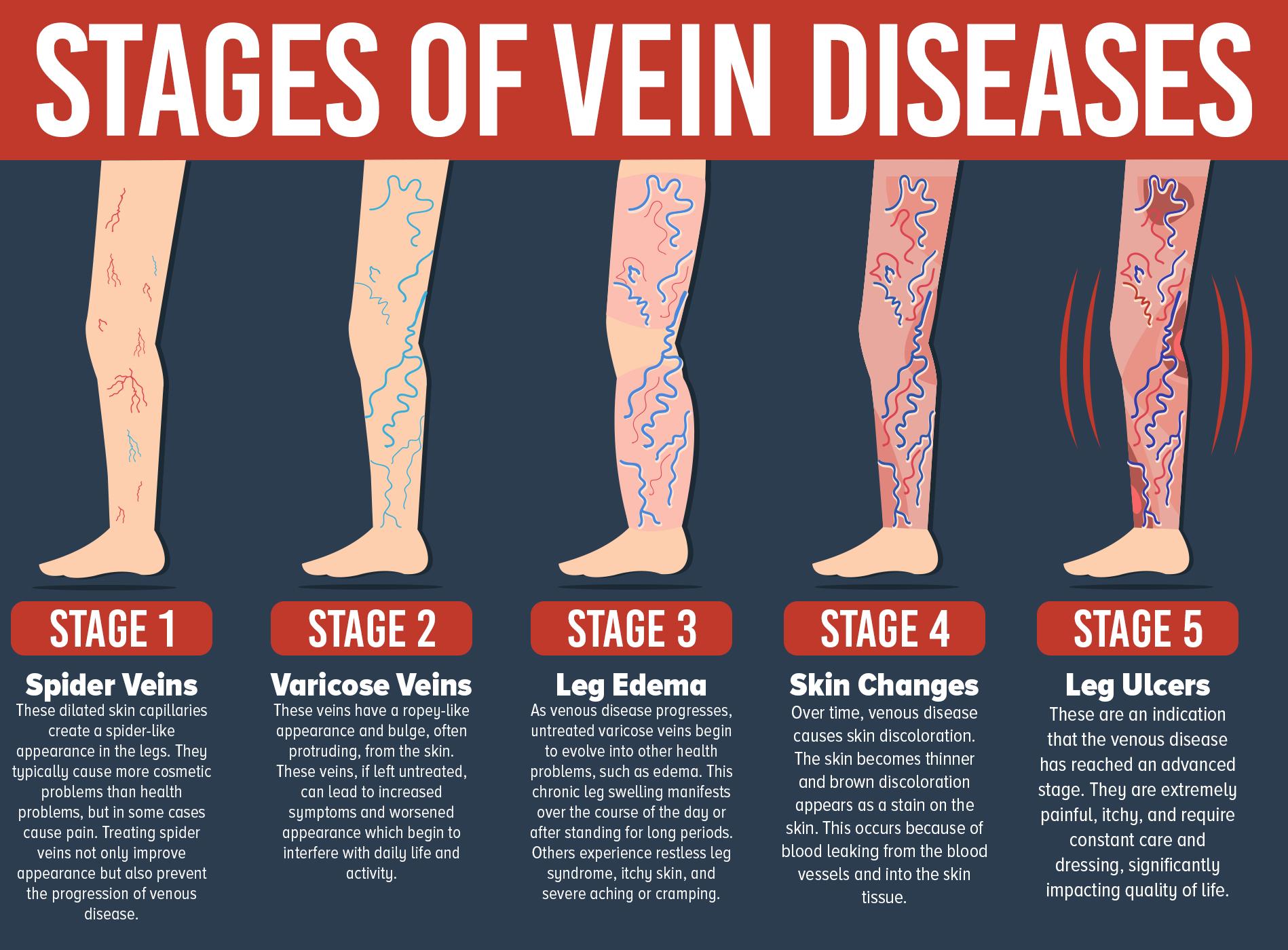 varicose vein infographic