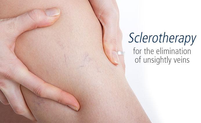 sclerotherapy san diego