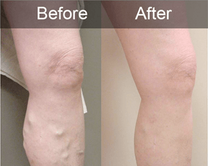 before after vein treatment