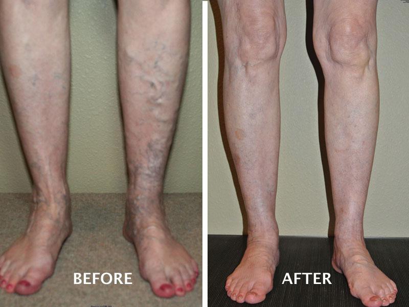 sclerotherapy before and after