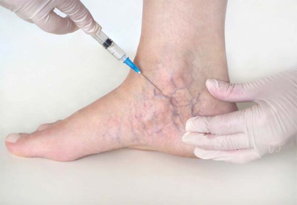 How Much Does Sclerotherapy Cost