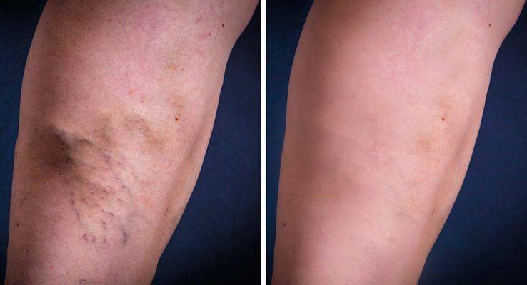 How Much Does Sclerotherapy Cost? | Will Insurance Cover Sclerotherapy