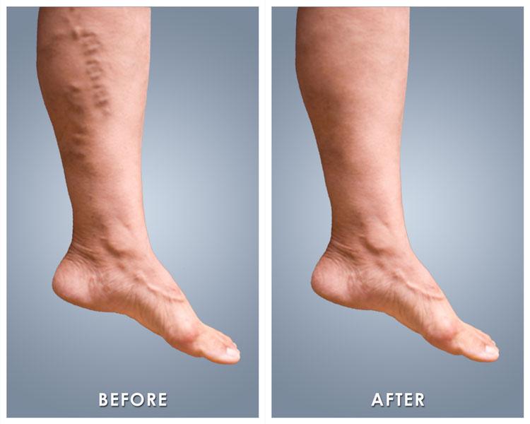 Laser Treatment vs. Surgery: Choosing a Varicose Veins Treatment That's  Right For You
